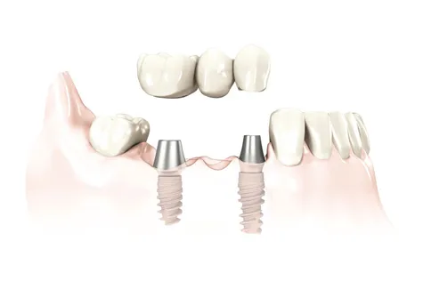 Multiple missing teeth
