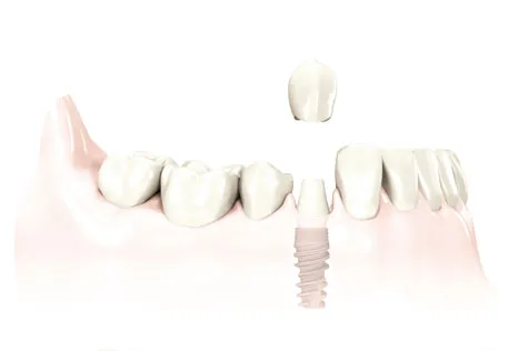 A single missing tooth